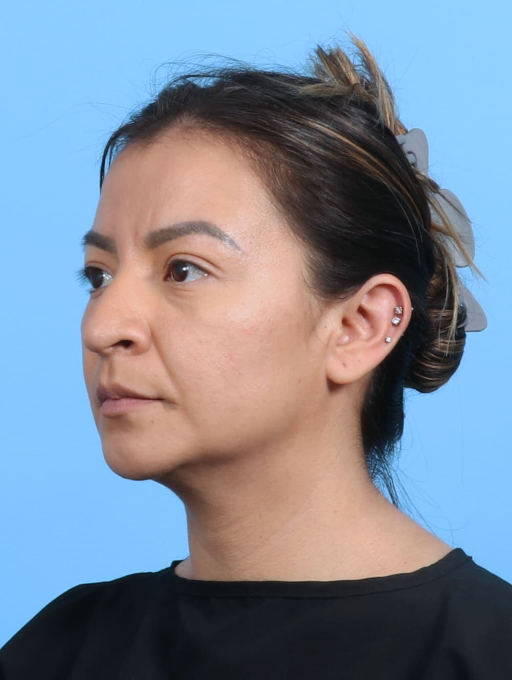 Rhinoplasty case #3279 before, image 3