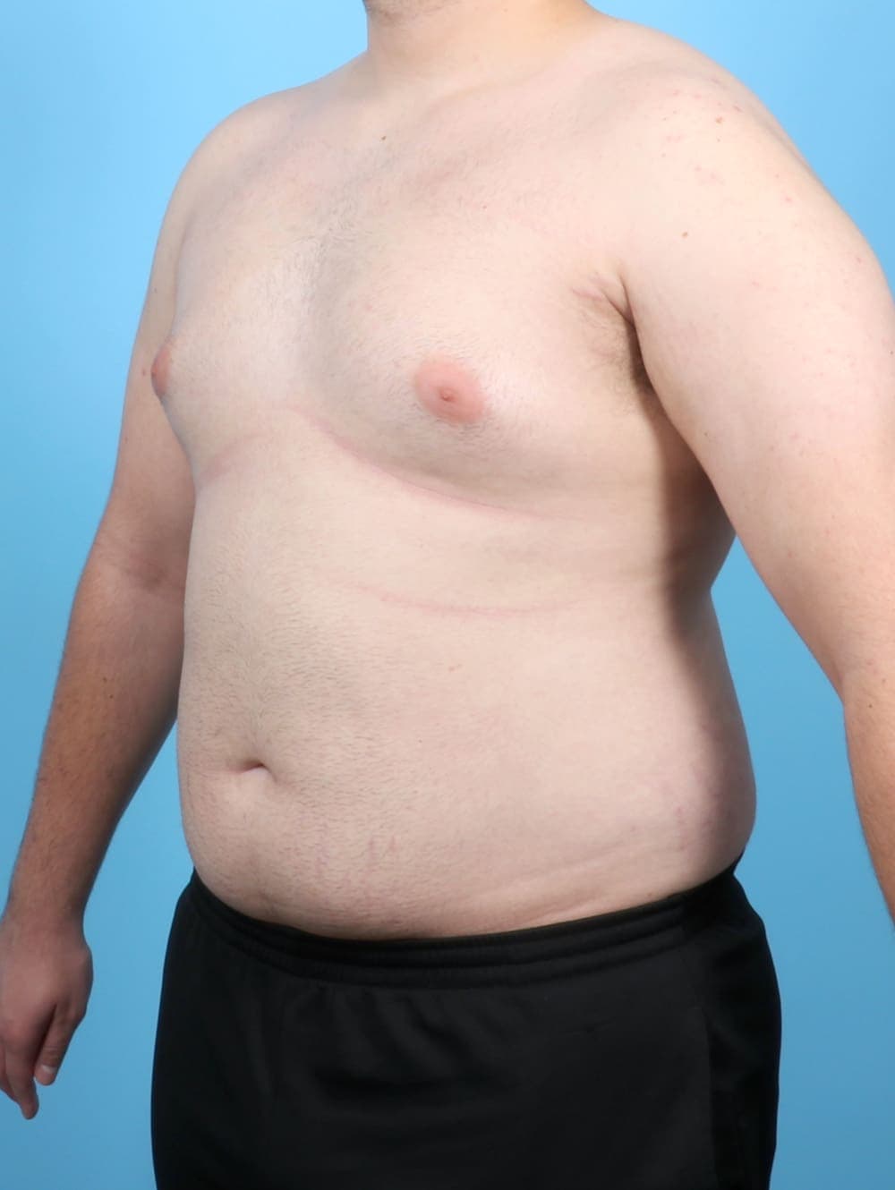 Male Breast Reduction case #6451 before, image 2