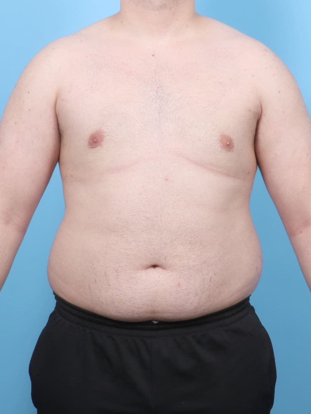 Male Breast Reduction case #6451 after, image 1