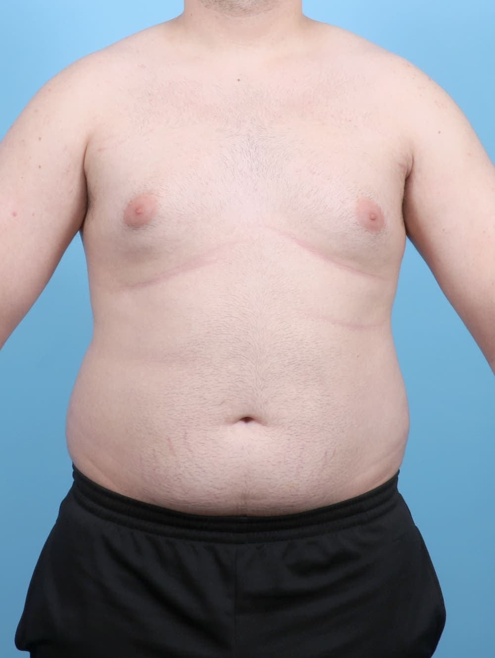 Male Breast Reduction case #6451 before, image 1