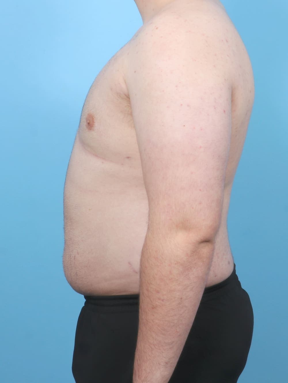 Male Breast Reduction case #6451 after, image 3