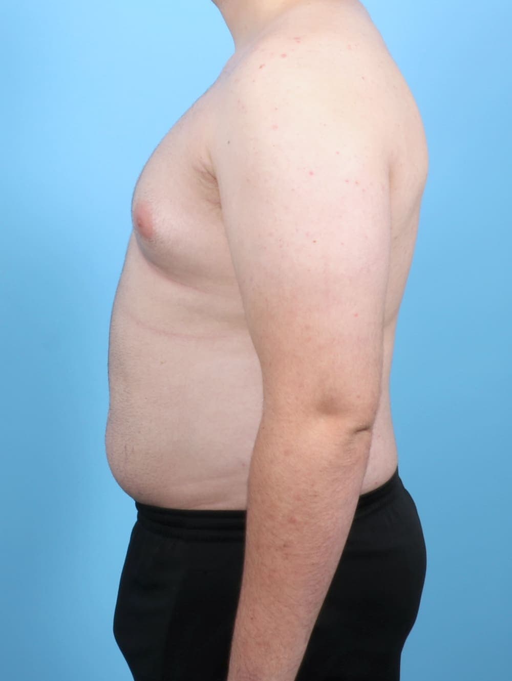 Male Breast Reduction case #6451 before, image 3