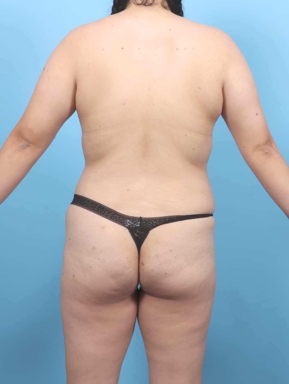 Mommy Makeover case #7104 before, image 4