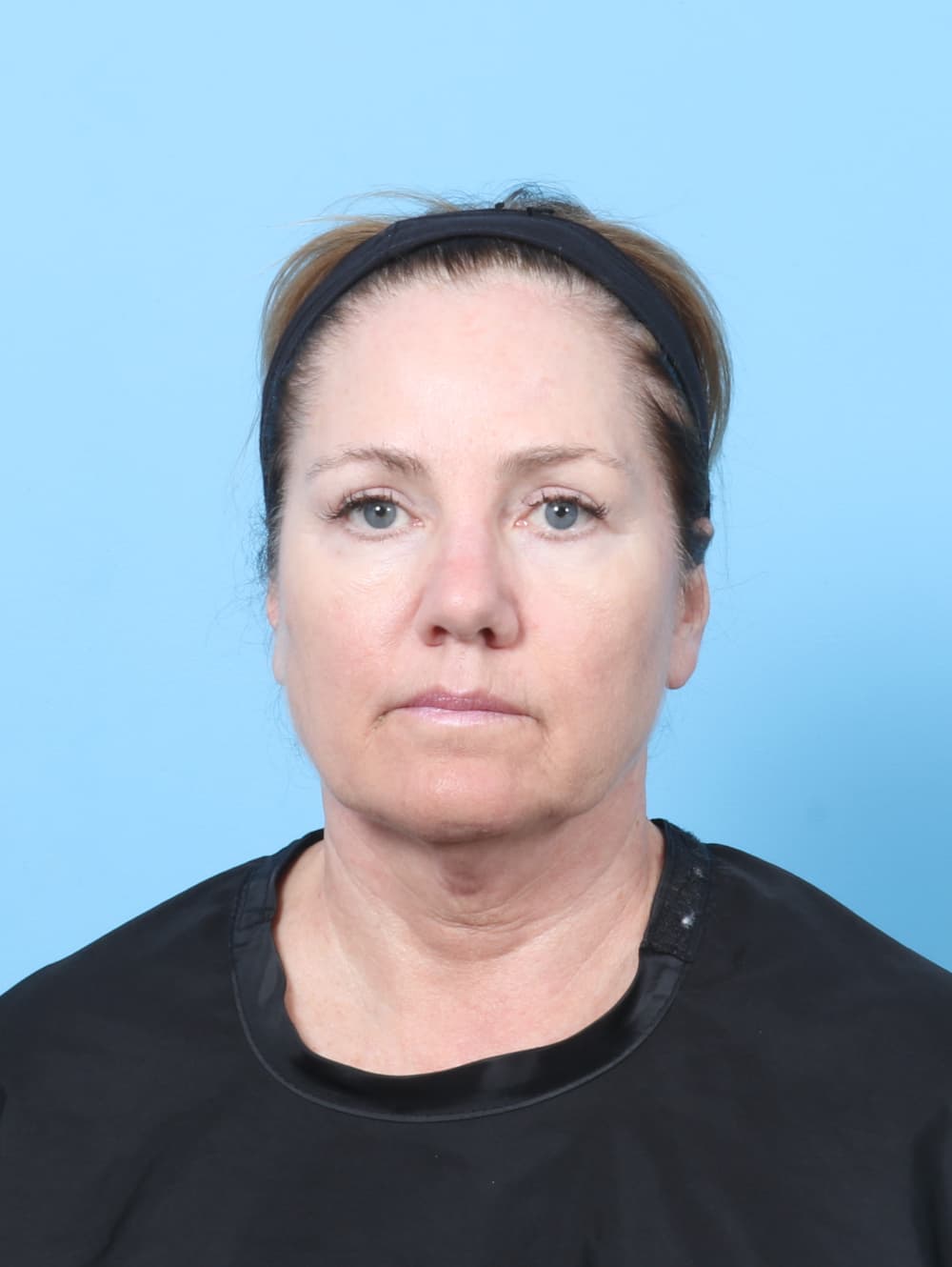 Eyelid Surgery case #8298 after