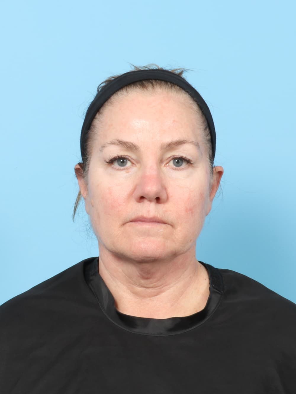 Eyelid Surgery case #8298 before