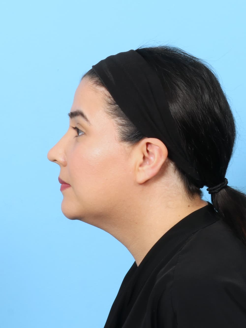 Facial Liposuction case #7897 after, image 3