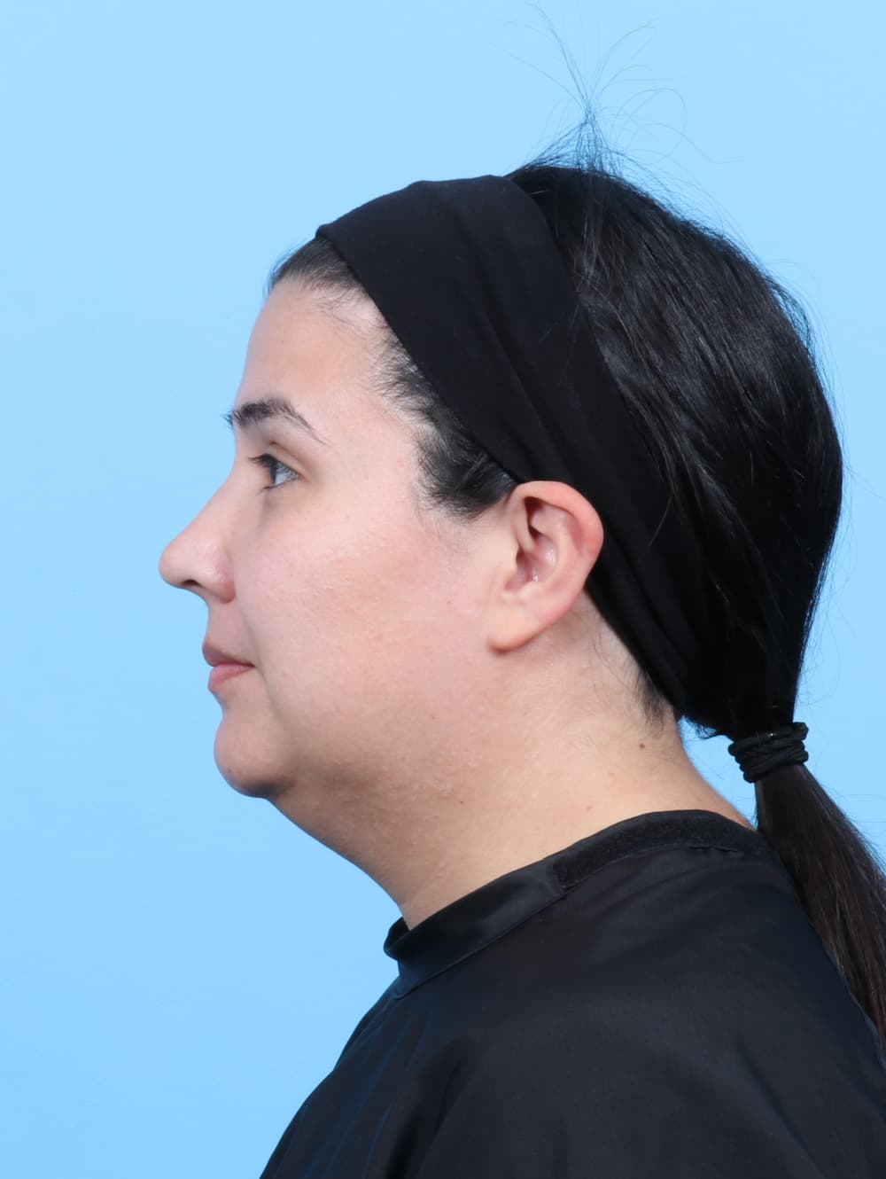 Facial Liposuction case #7897 before, image 3