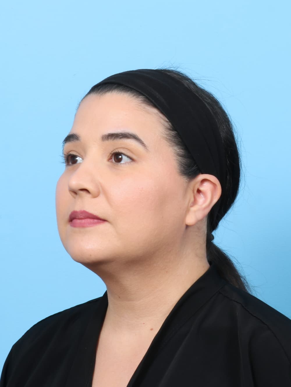 Facial Liposuction case #7897 after, image 2