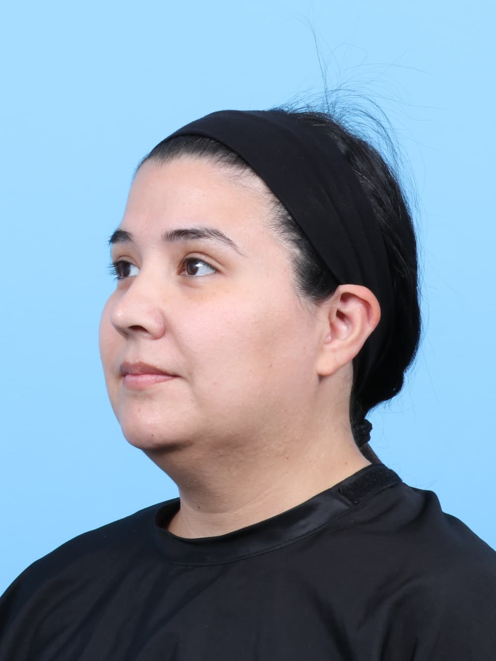 Facial Liposuction case #7897 before, image 2