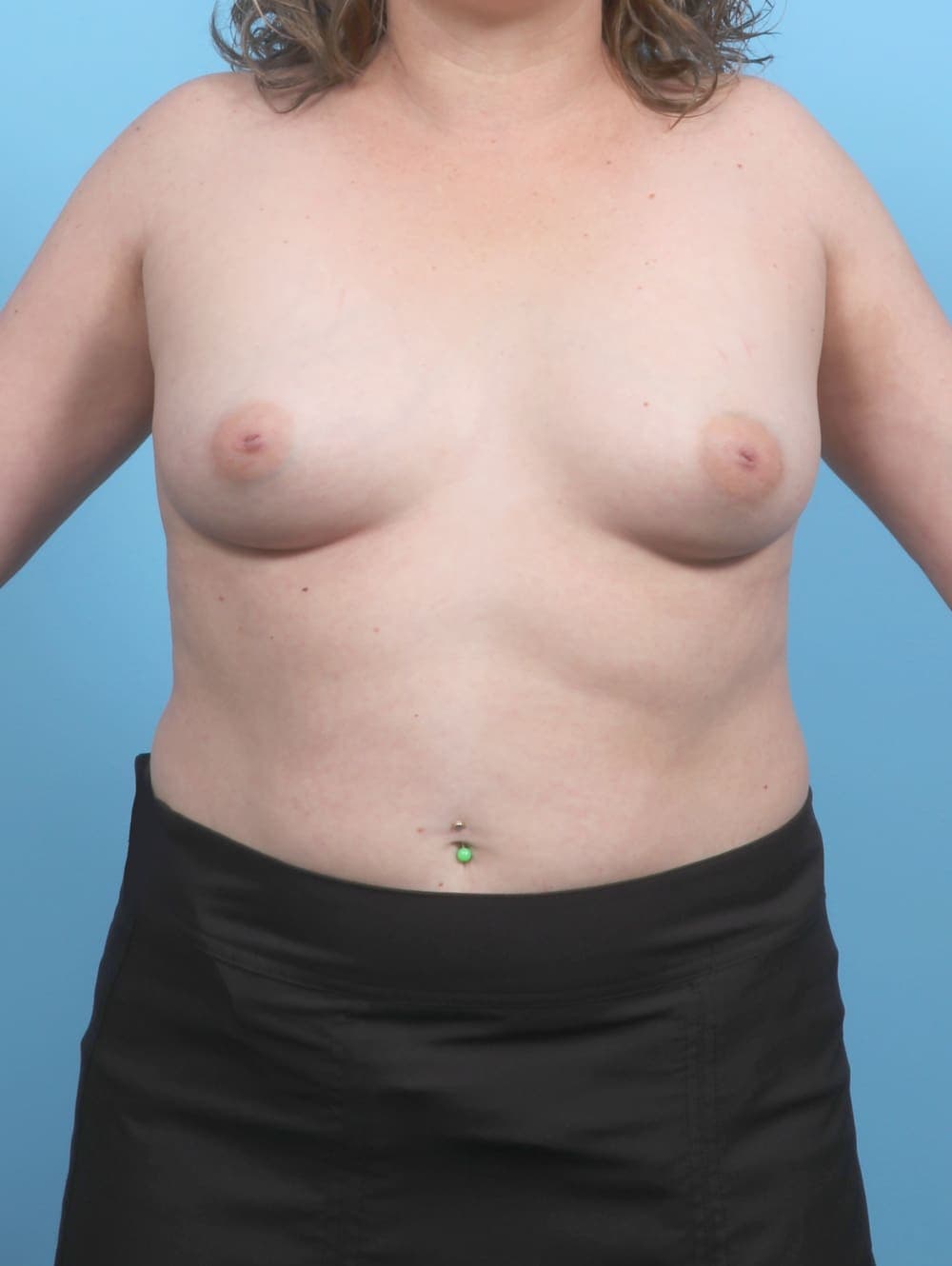 Breast Augmentation case #6759 before, image 1