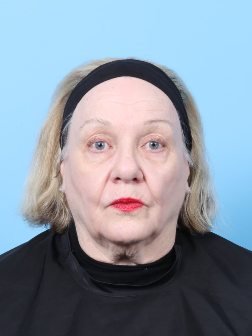 Eyelid Surgery case #8954 after