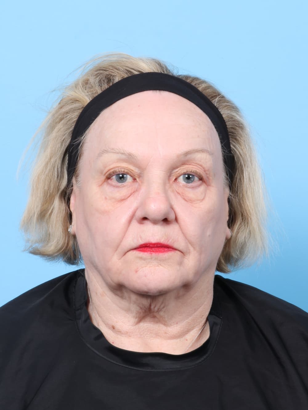 Eyelid Surgery case #8954 before