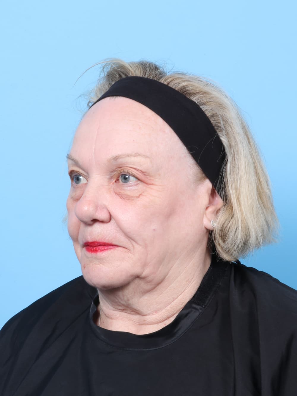 Eyelid Surgery case #8954 before, image 2