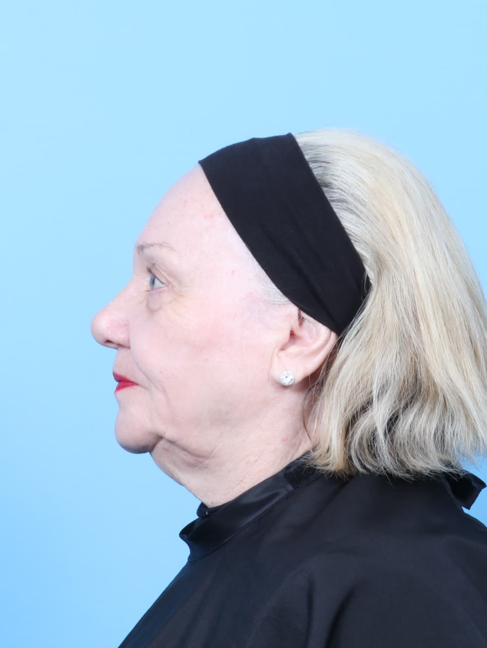 Eyelid Surgery case #8954 after, image 3