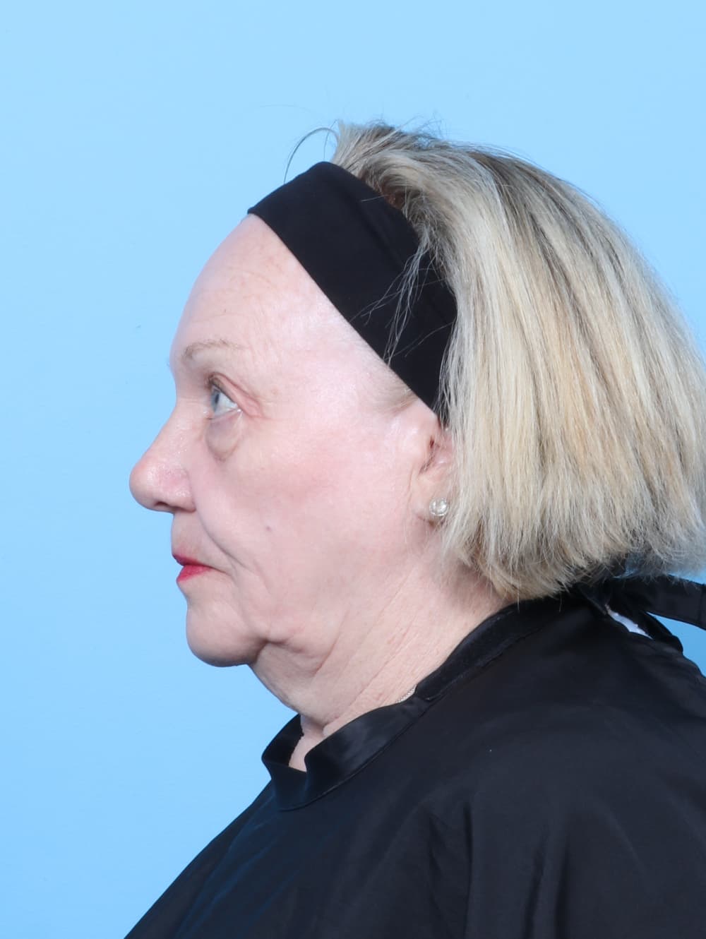 Eyelid Surgery case #8954 before, image 3