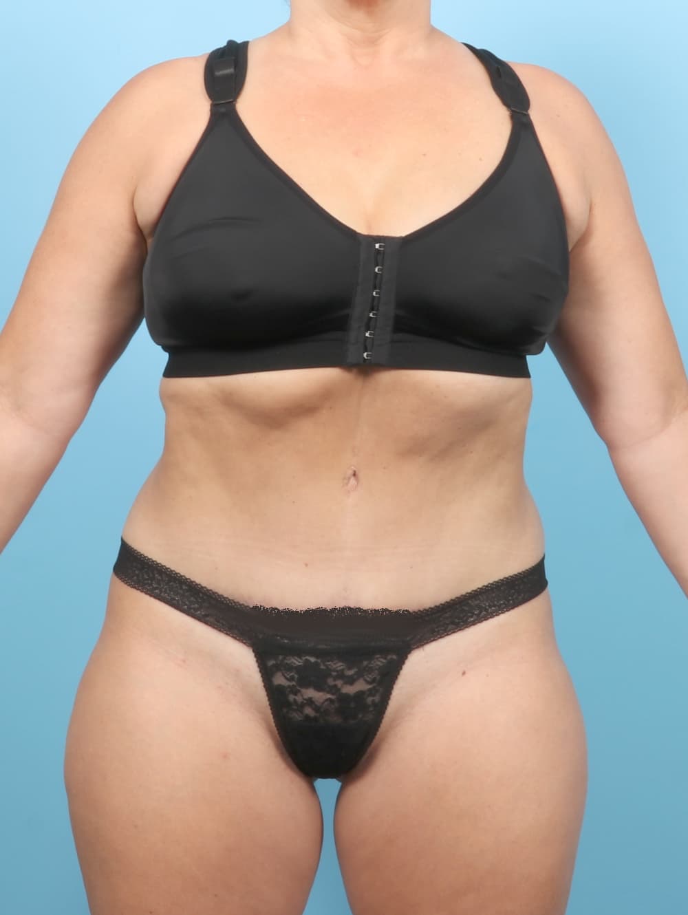 Tummy Tuck case #7265 after, image 1
