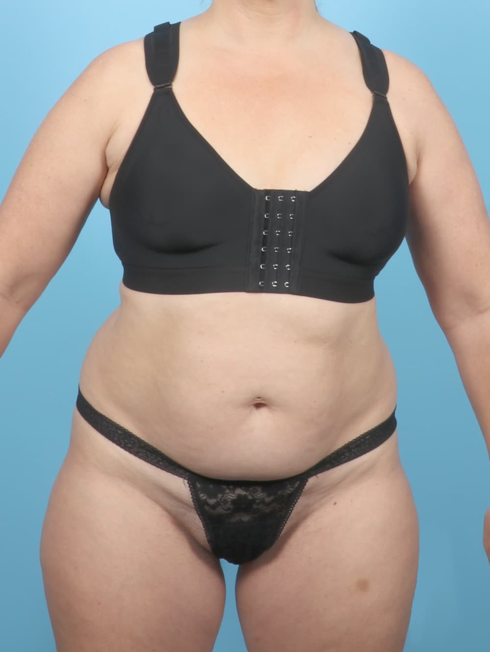 Tummy Tuck case #7265 before, image 1