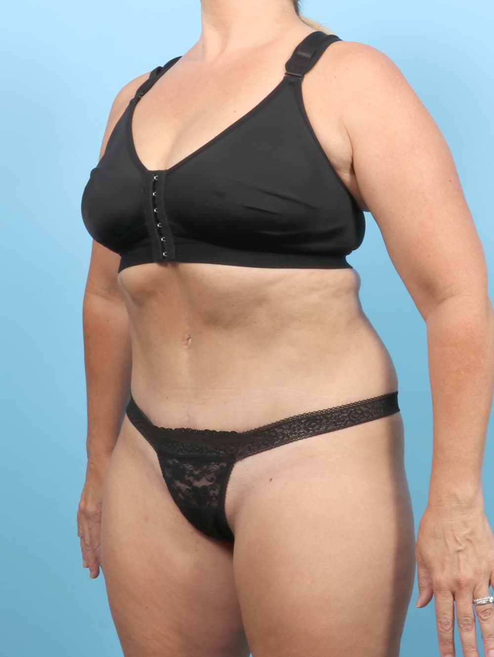 Tummy Tuck case #7265 after, image 2