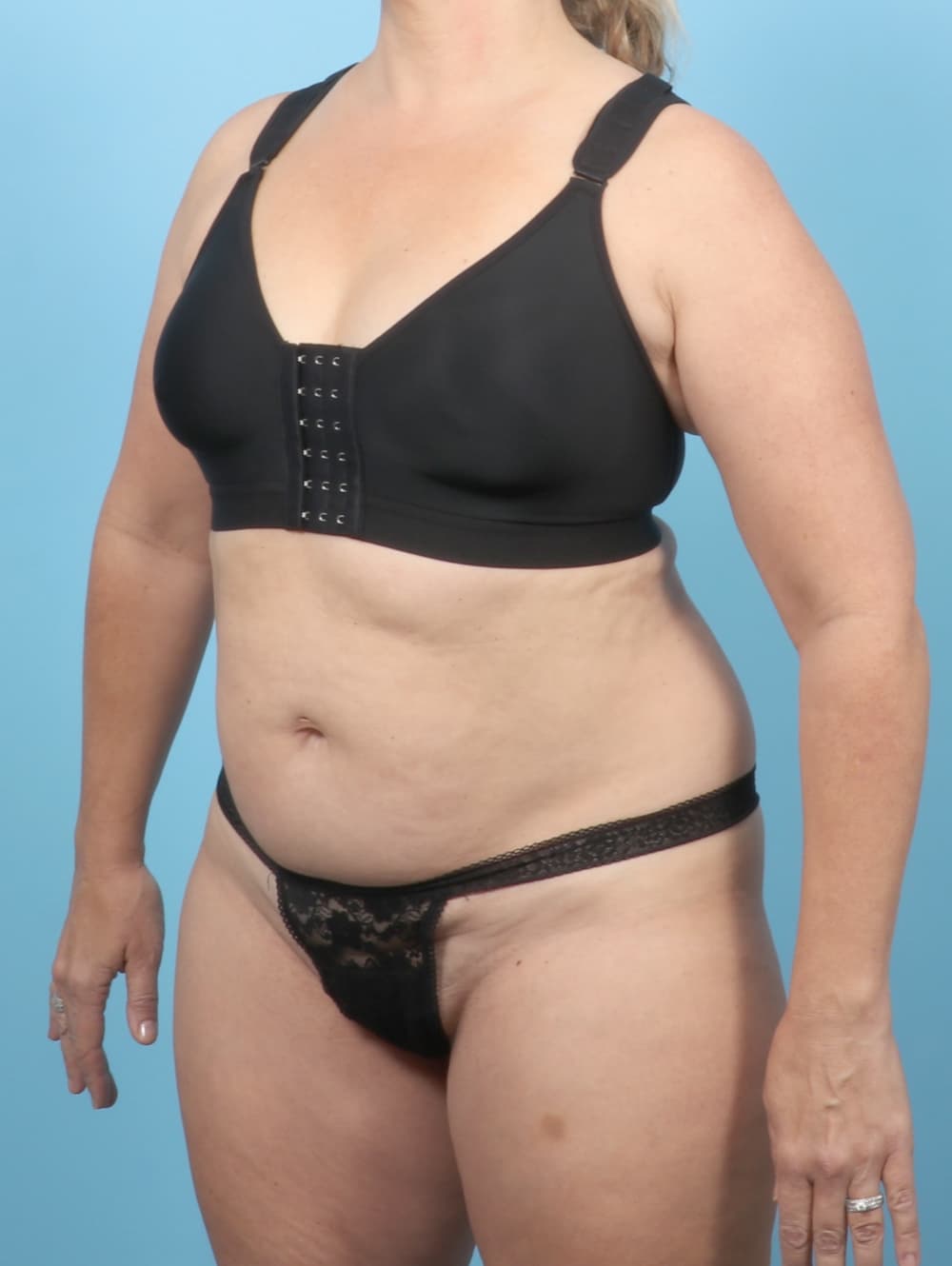 Tummy Tuck case #7265 before, image 2