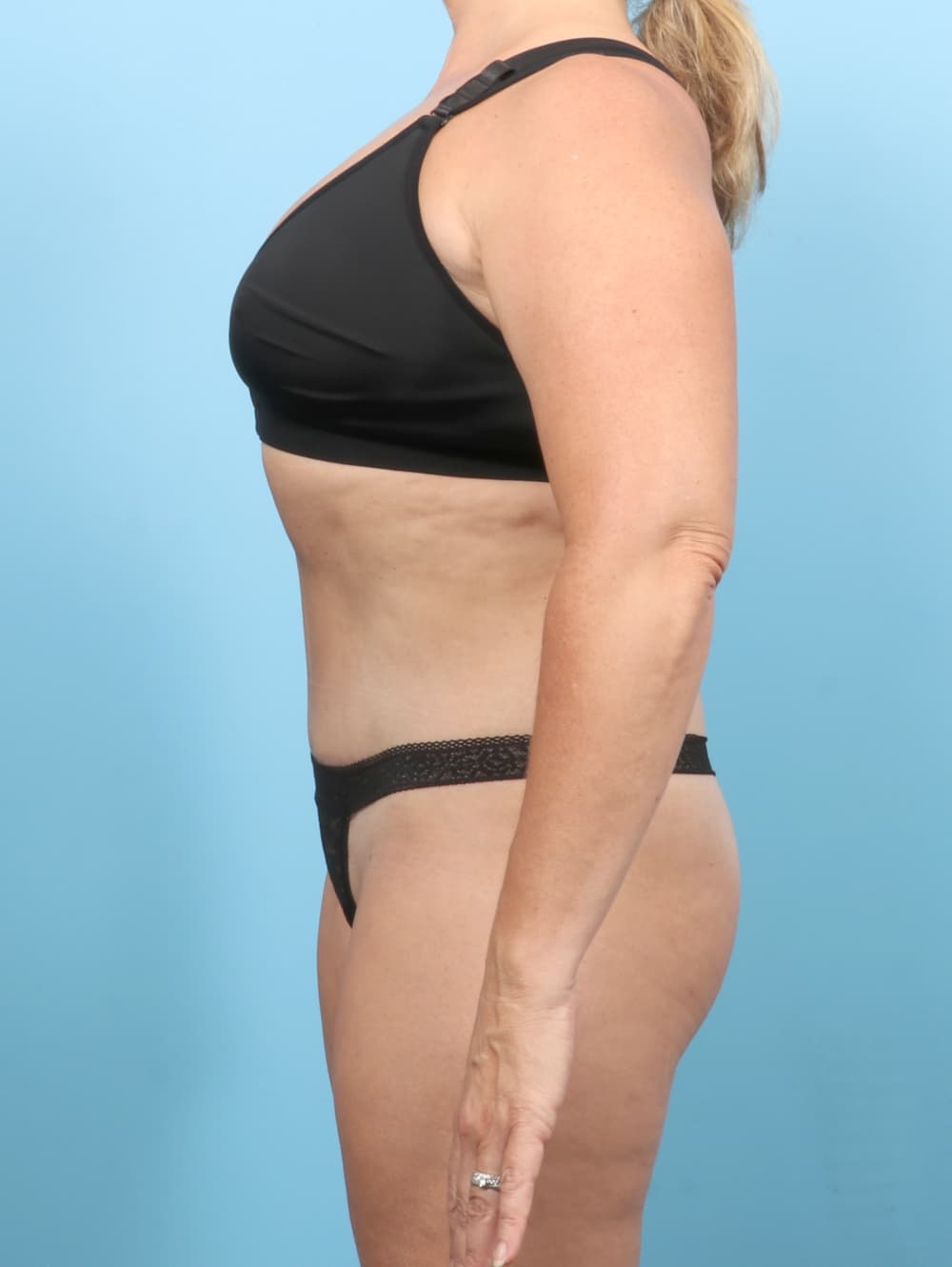 Tummy Tuck case #7265 after, image 3