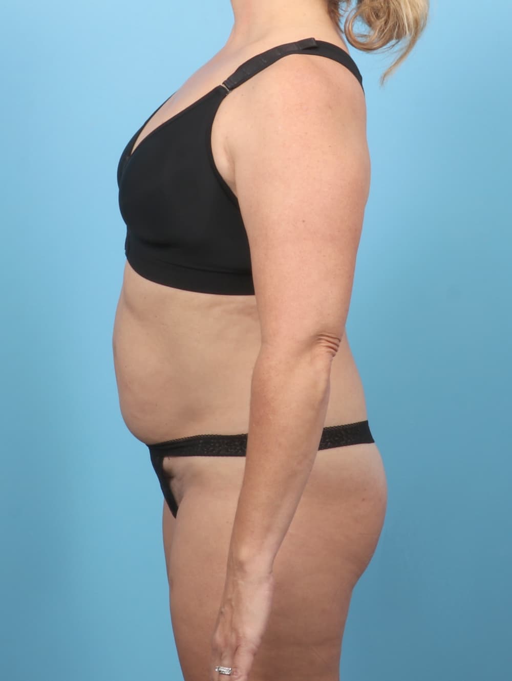 Tummy Tuck case #7265 before, image 3