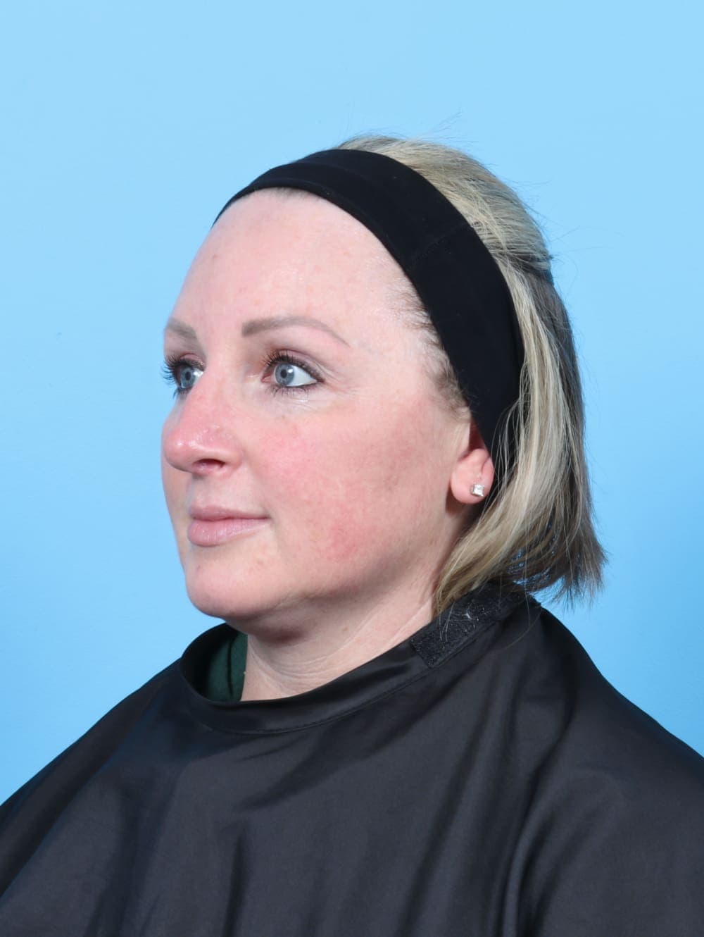 Rhinoplasty case #6205 after, image 3