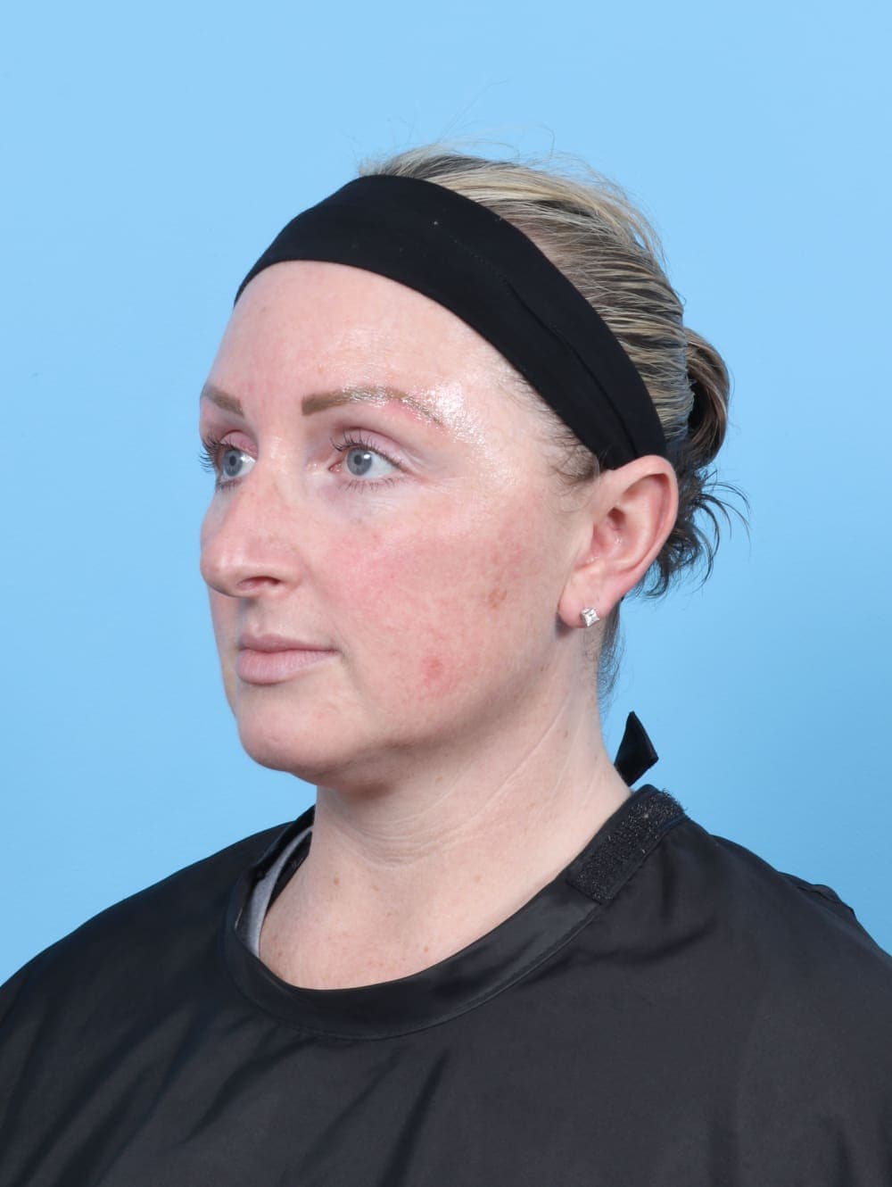 Rhinoplasty case #6205 before, image 3