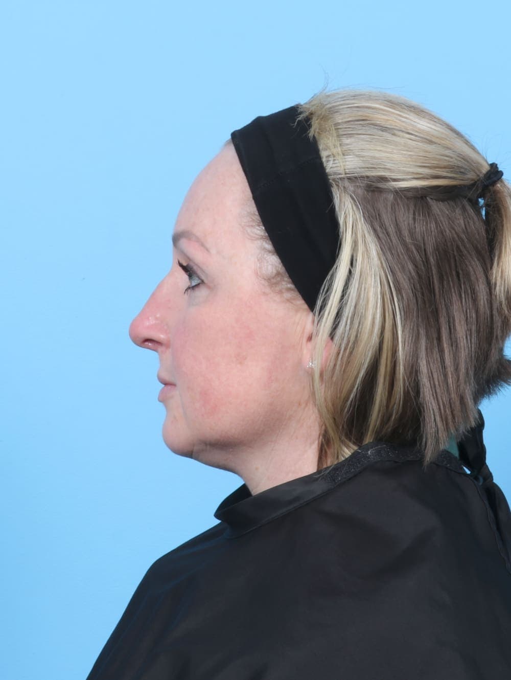 Rhinoplasty case #6205 after