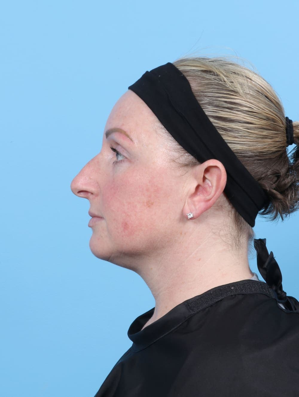 Rhinoplasty case #6205 before