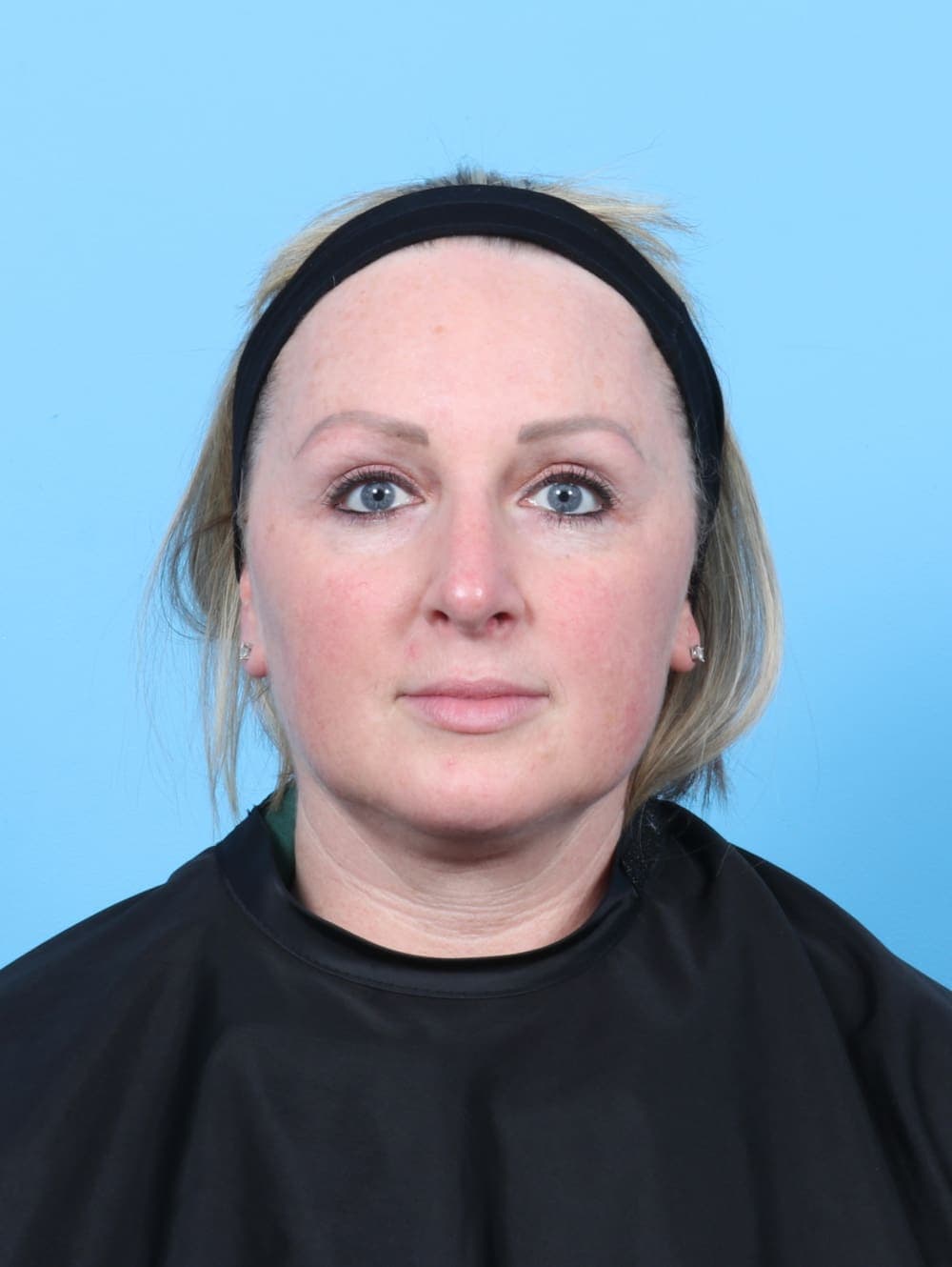 Rhinoplasty case #6205 after, image 2