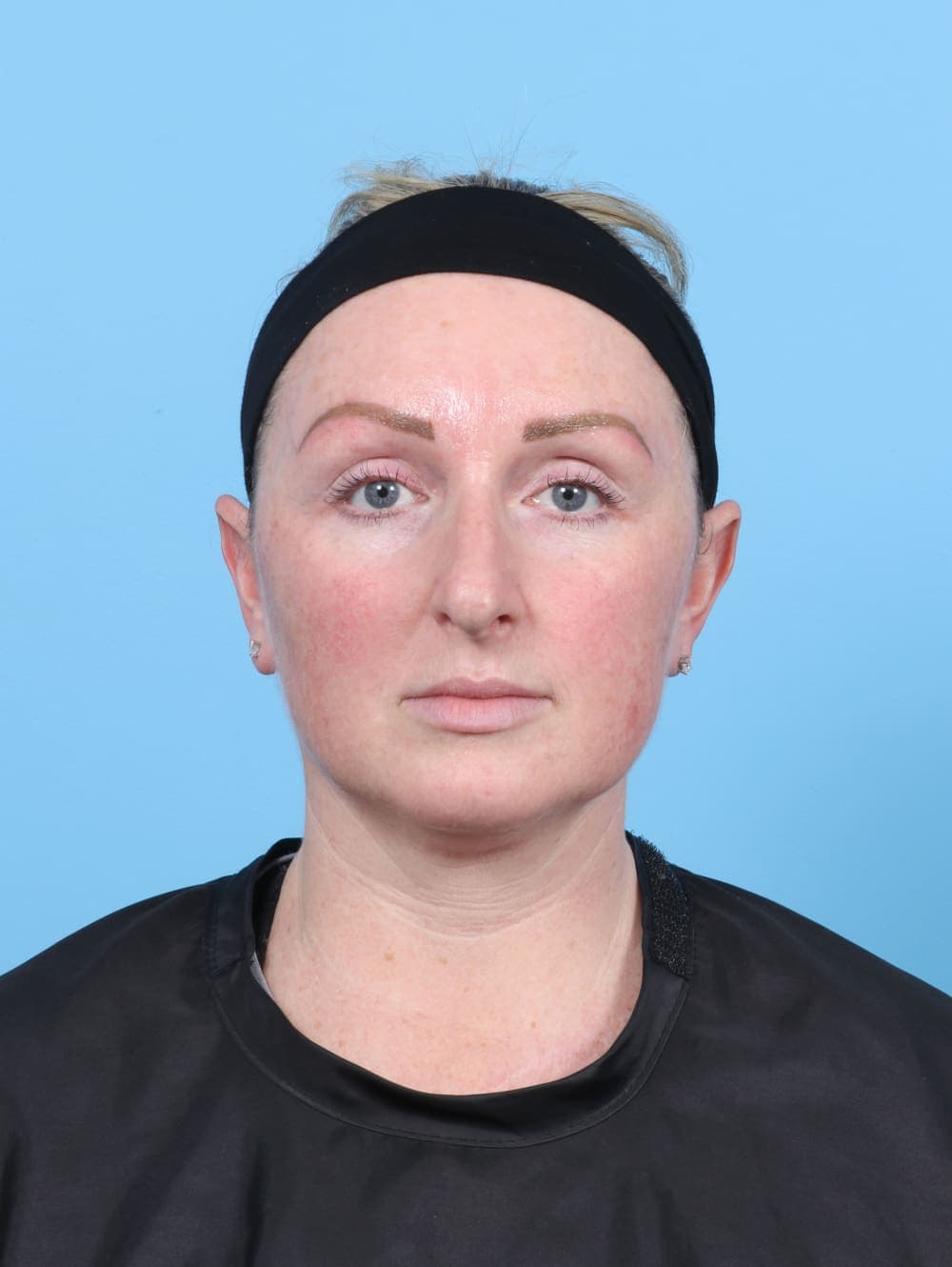 Rhinoplasty case #6205 before, image 2