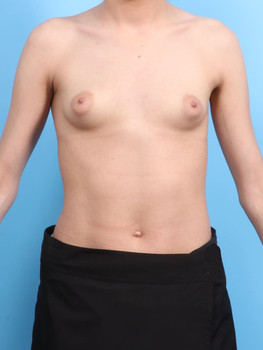 Breast Augmentation case #2179 before, image 1