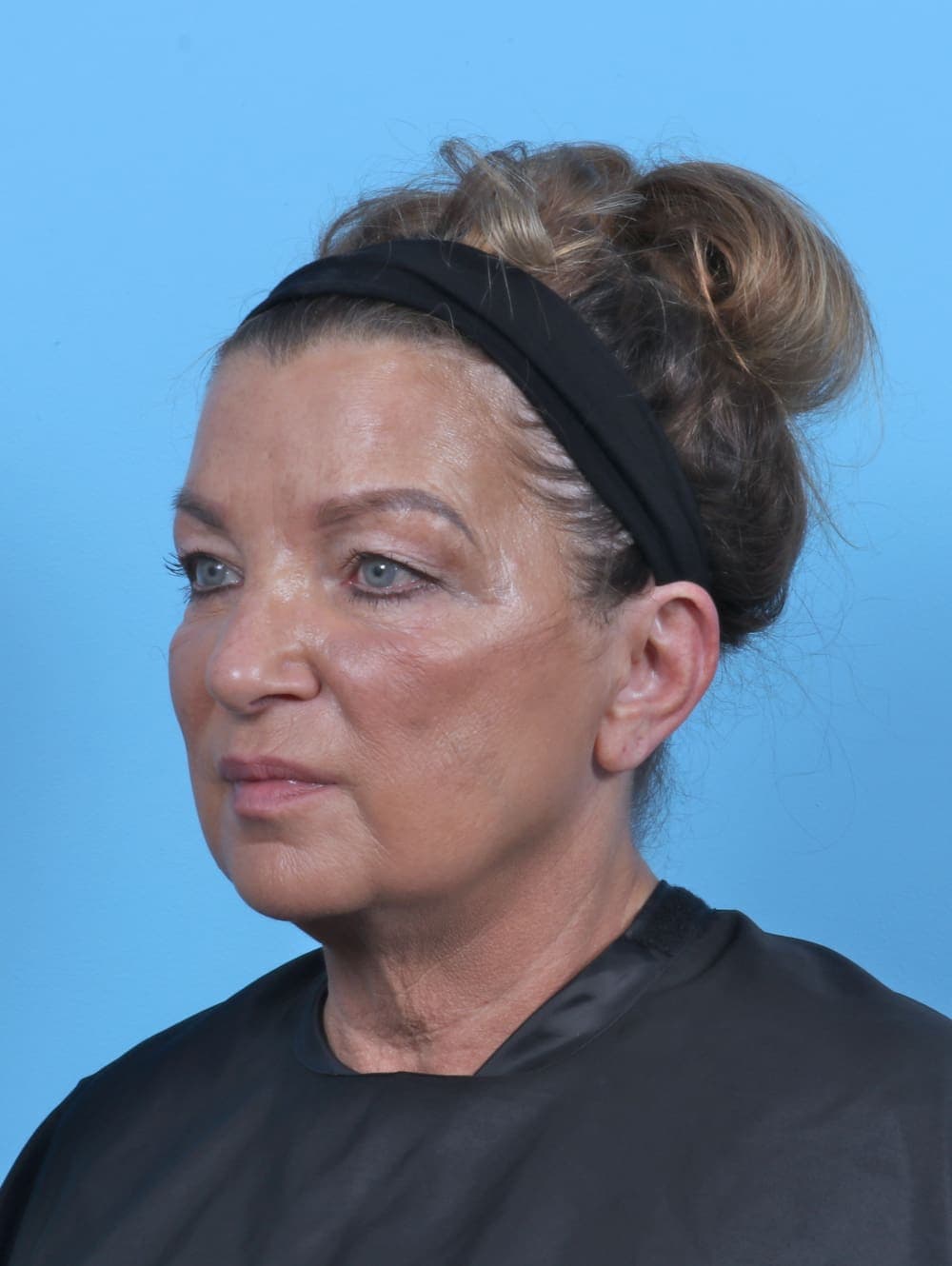 Eyelid Surgery case #5739 before, image 2