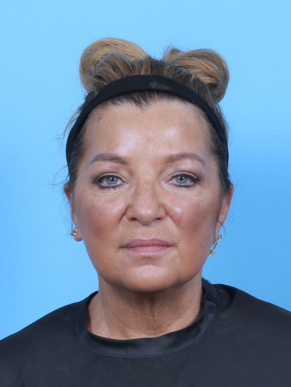 Eyelid Surgery case #5739 after, image 1