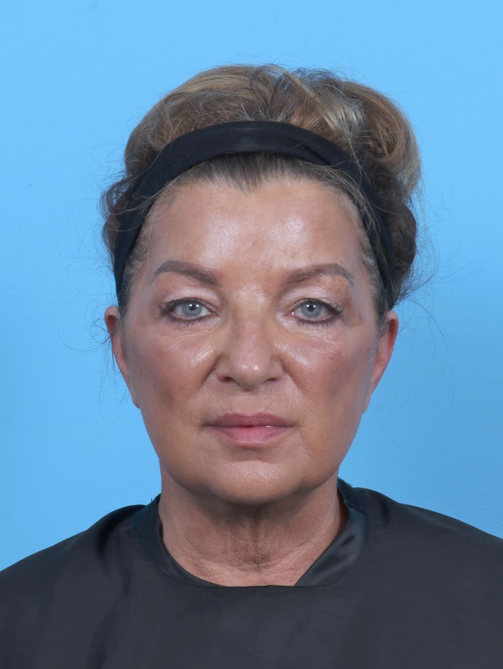 Eyelid Surgery case #5739 before, image 1
