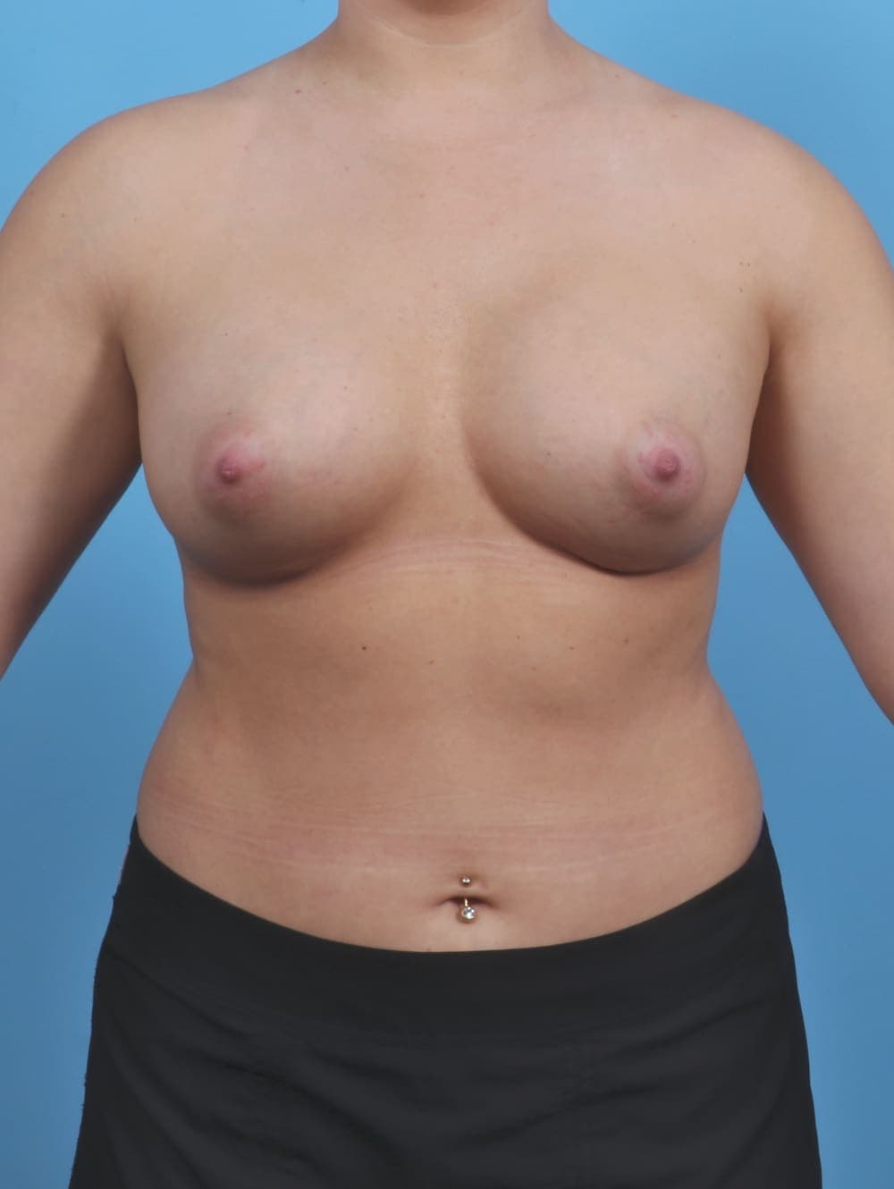 Breast Augmentation case #4934 after, image 1