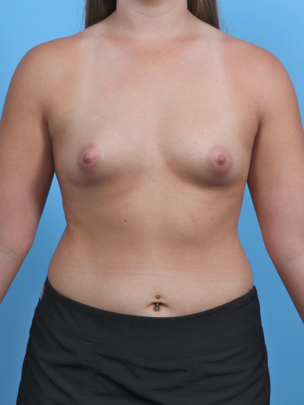 Breast Augmentation case #4934 before, image 1