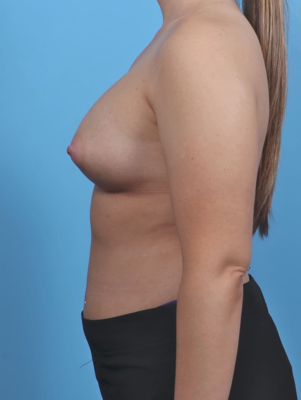 Breast Augmentation case #4934 after, image 3