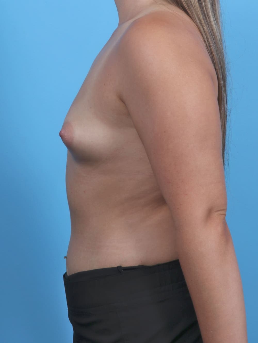 Breast Augmentation case #4934 before, image 3