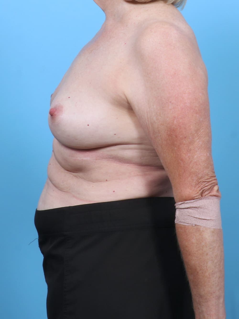 Breast Lift/Reduction case #6114 after, image 3