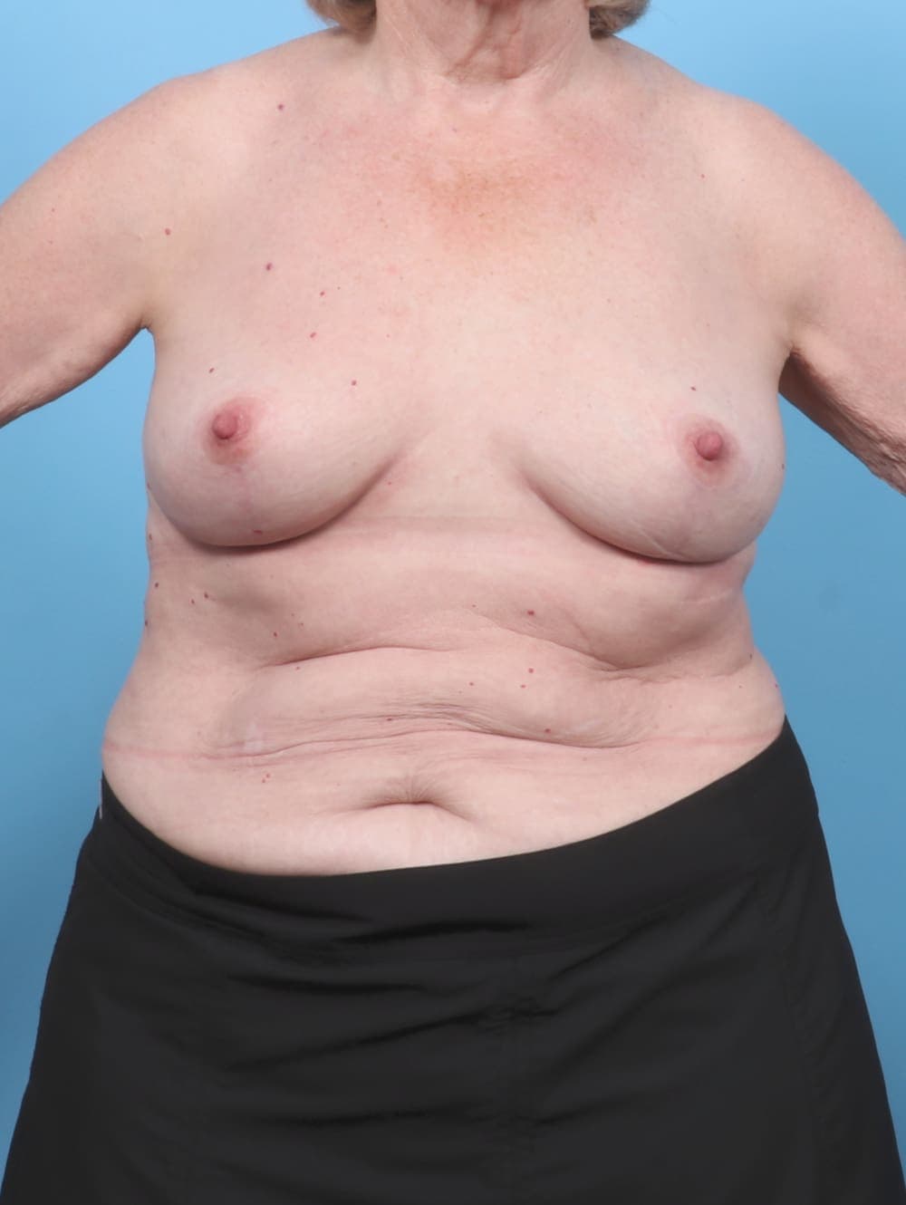 Breast Lift/Reduction case #6114 after, image 1