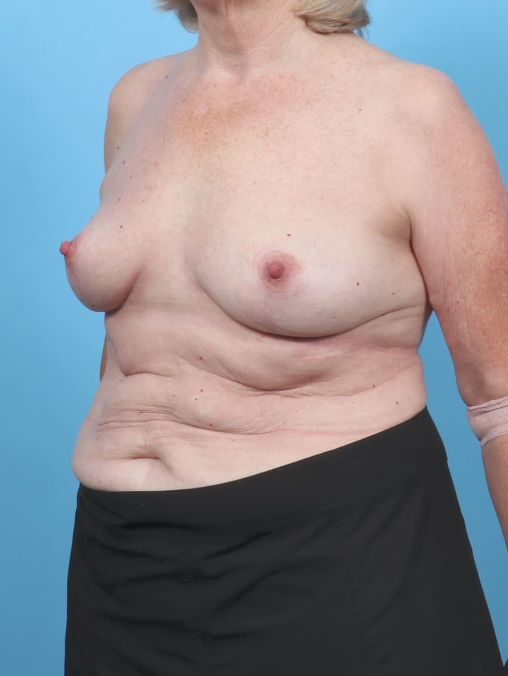 Breast Lift/Reduction case #6114 after, image 2
