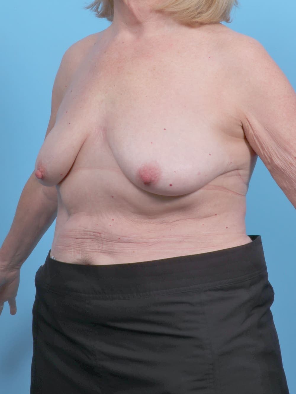 Breast Lift/Reduction case #6114 before, image 2