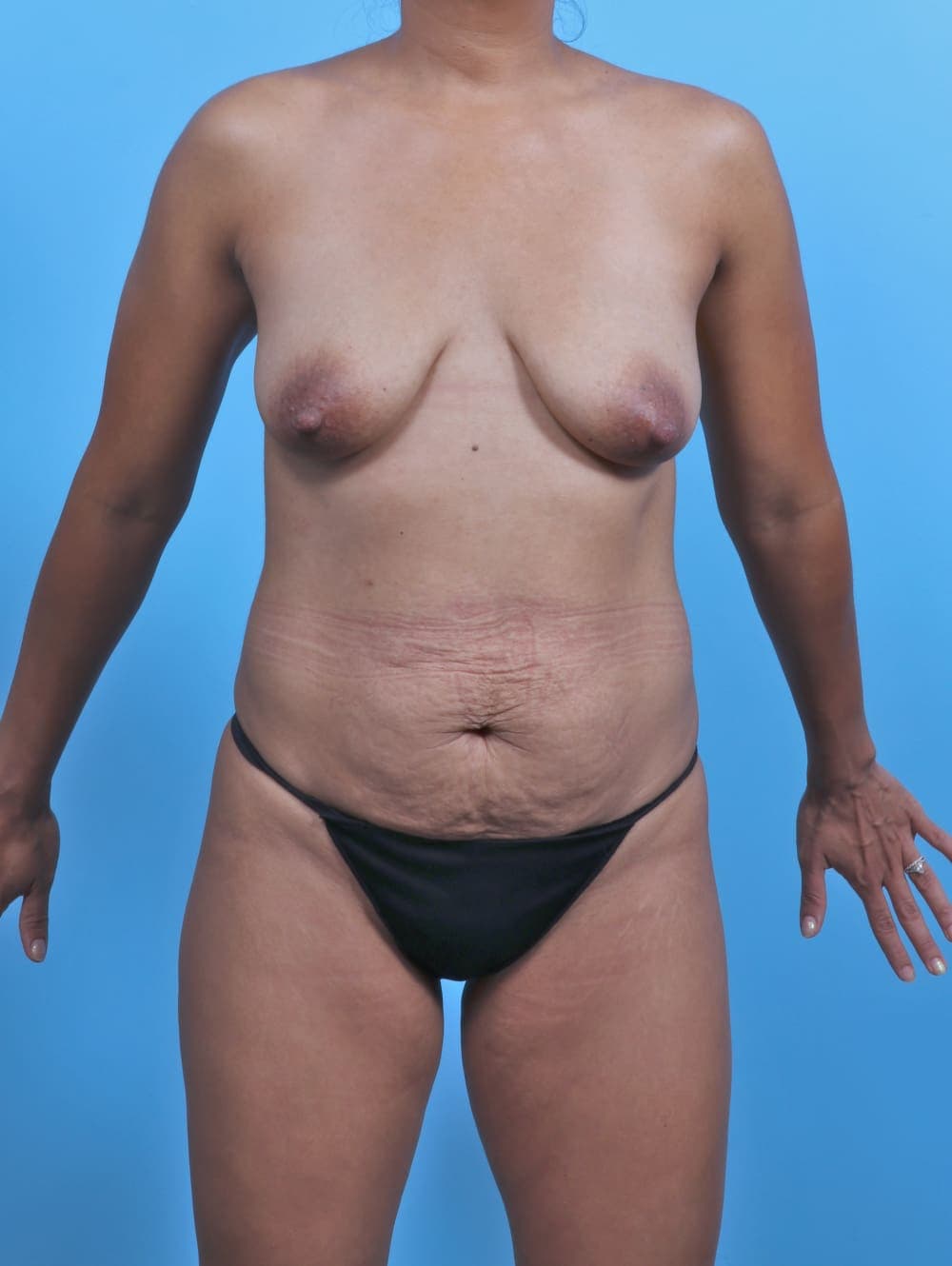 Mommy Makeover case #4983 before, image 1