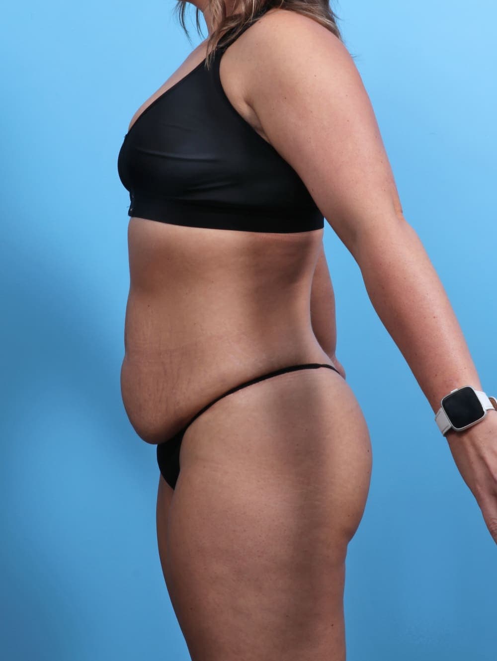 Tummy Tuck case #3510 before, image 3