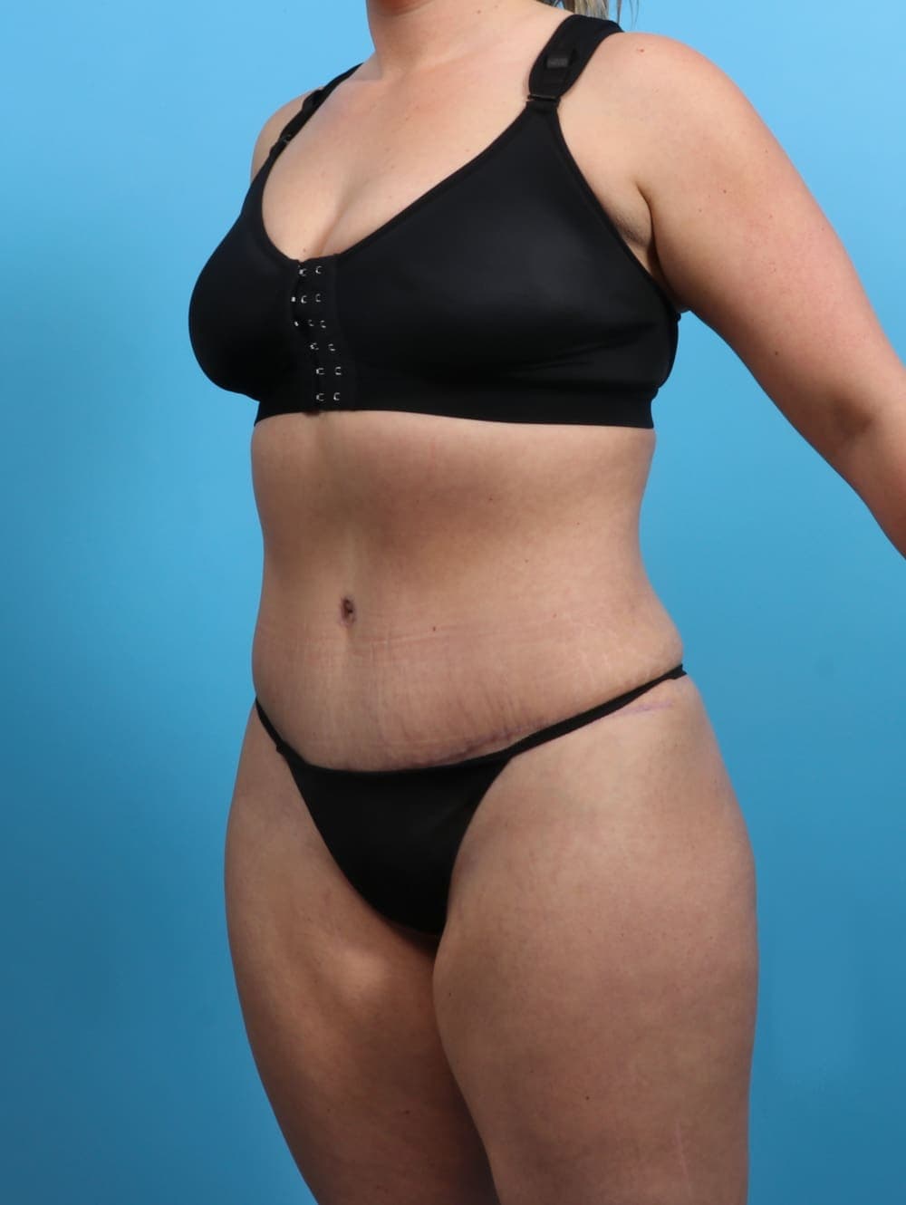 Tummy Tuck case #3510 after, image 2