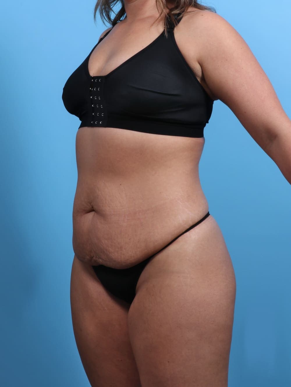 Tummy Tuck case #3510 before, image 2