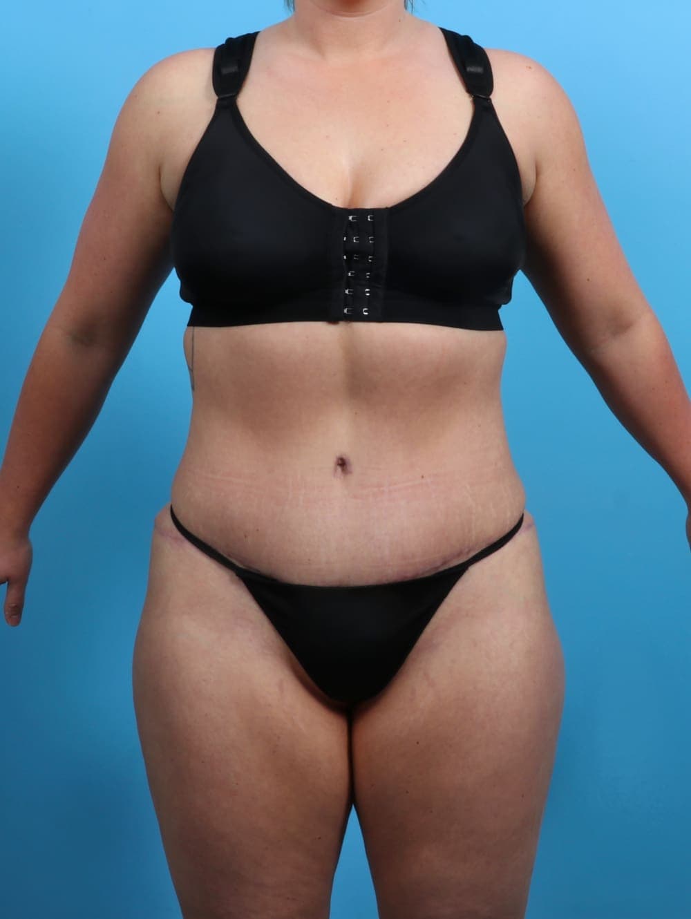 Tummy Tuck case #3510 after, image 1