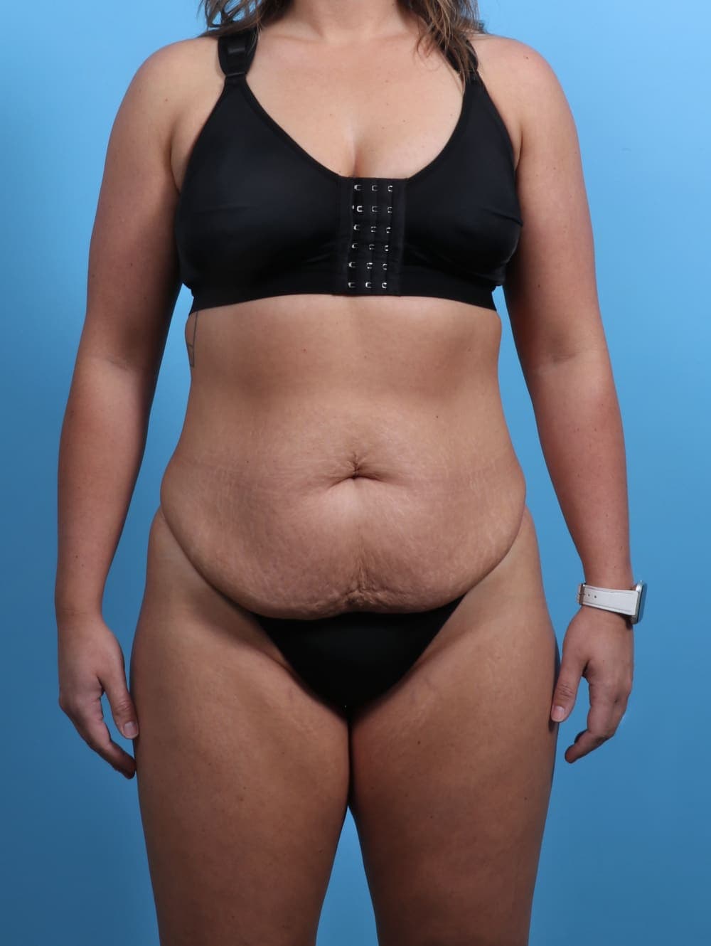 Tummy Tuck case #3510 before, image 1