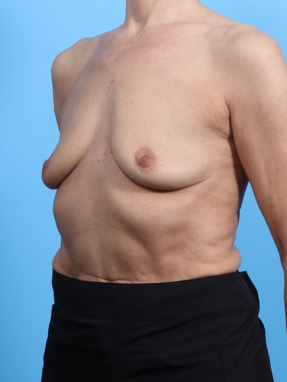 Breast Augmentation case #3452 before, image 2